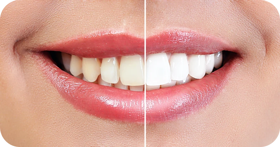 Eclaircir les dents dentiste esthétique lyon