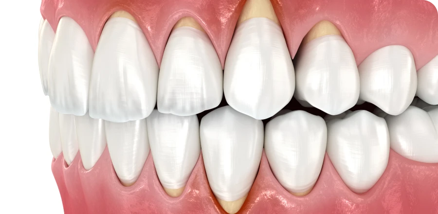 Déchaussement, parodontite, gingivite, saignement : soins dentaires à Lyon 8