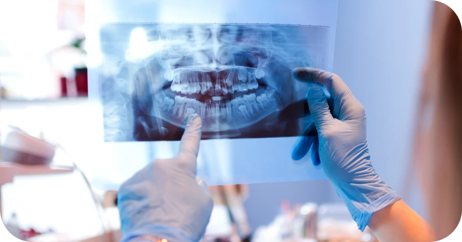 Dentiste Lyon 8 : dégagement de dents incluses, votre sourire saine