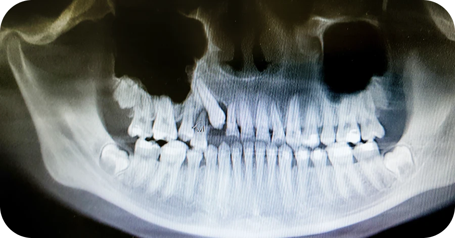 Dents incluse chirurgie dentaire grange blanche lyon