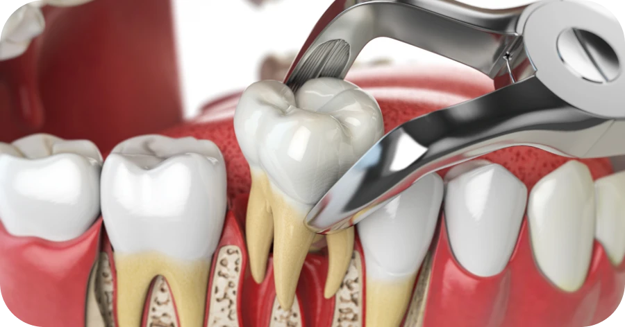 Extraction dents de laits Lyon dentiste enfant