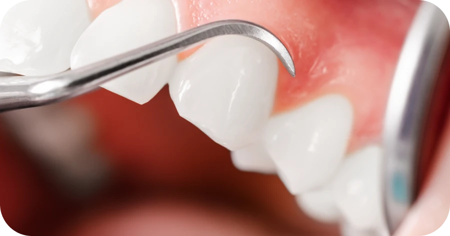 Blanchiment dentaire : dentiste à Lyon au Cabinet Grange Blanche