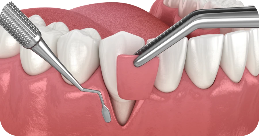 Pose des facettes dentaires au Cabinet Grange Blanche à Lyon 8