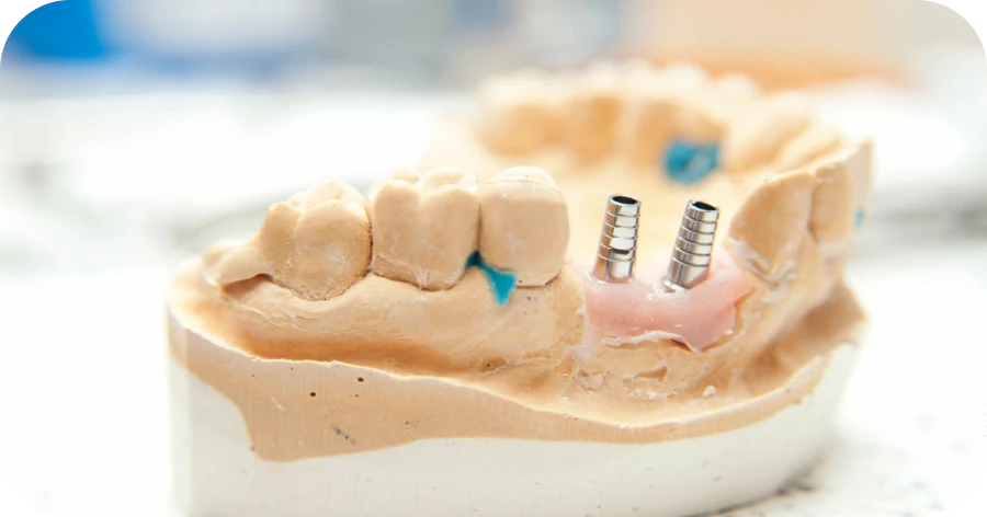 Dentiste Lyon 8 : greffe osseuse, implantologie, soins dentaires