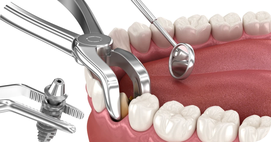 Implantologie immédiate : chirurgiens-dentistes Lyon 8