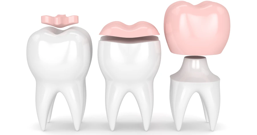 inlays et onlays lyon dentiste esthétique
