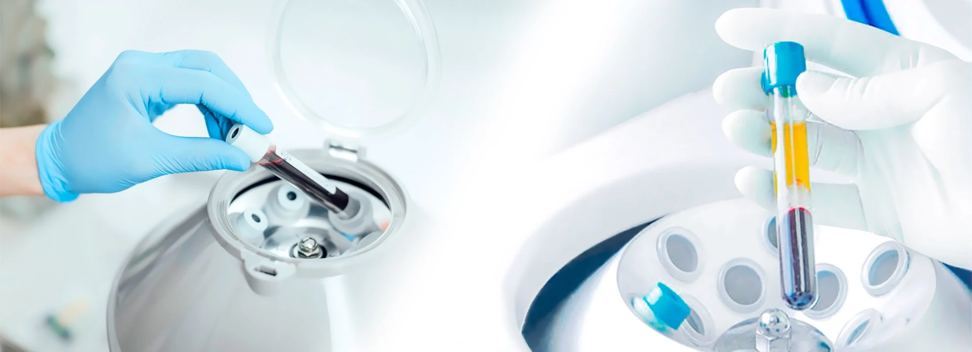 Chirurgie buccale à Lyon 8 : PRF