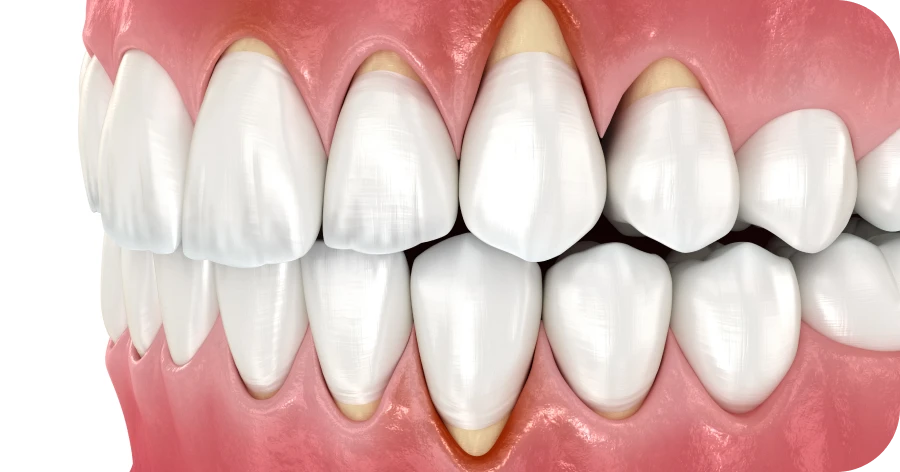 Déchaussement parodontologie dentiste lyon