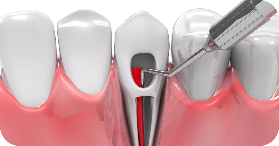 Retraitement de canal dentaire : Grange Blanche Lyon 8