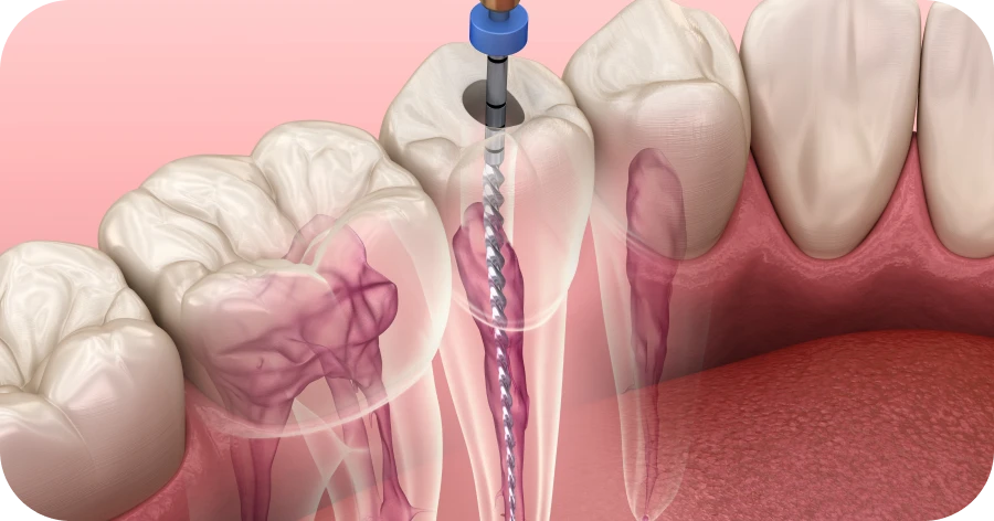 Traitement de la racine : Grange Blanche Lyon 8