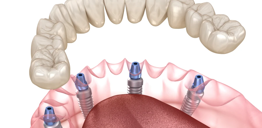 Perte des dents, edentement complet : le système All-On-X à Lyon 8