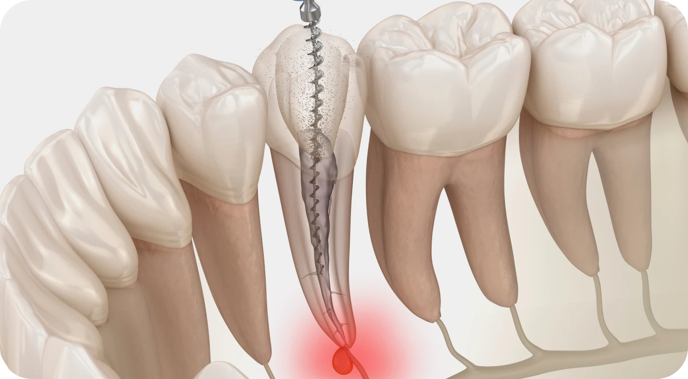 Chirurgien-dentiste Lyon 8 : endodontie, traitement endodontique