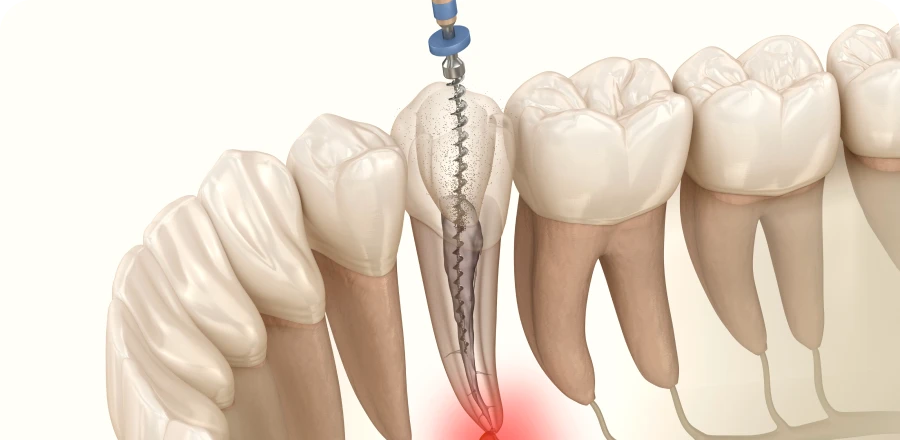 Rage de dents, pulpite, nécrose à Lyon 8 : soins dentaires, dentiste